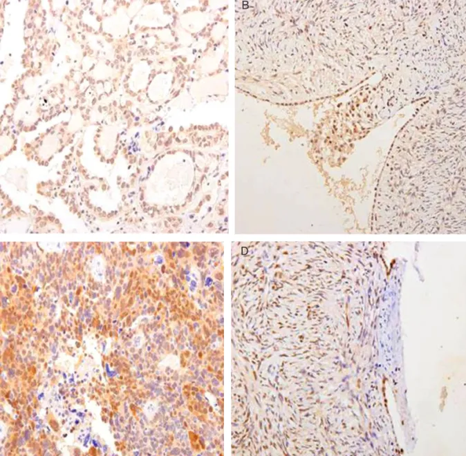 Fig. 2. The immunohistochemical staining of FAS-associated factor 1 (FAF1) and heat shock protein 70 (HSP70) expression  in normal ovary and ovarian cancer