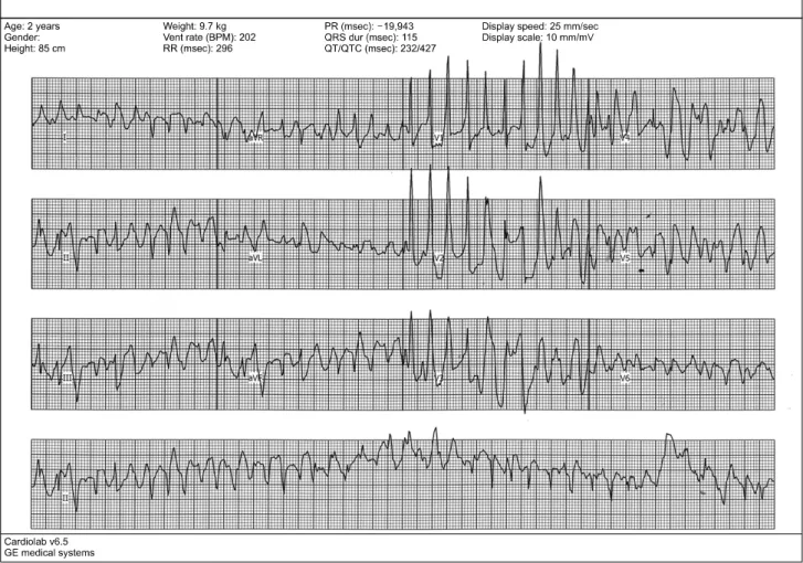 Fig. 1. Preoperative electrophysiologic study showing polymorphic ventricular tachycardia induced by single ventricular pacing.