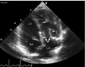 Fig. 3. Excised specimen of supratricuspid ring.