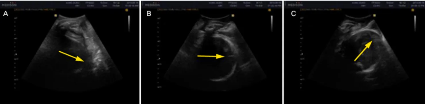 Fig. 6. Head direction on intrapartum translabial ultrasound. Categorization of fetal head direction (indicated by arrows) in longitudinal translabial so- so-nograms: (A) downward, (B) horizontal, and (C) upward direction.