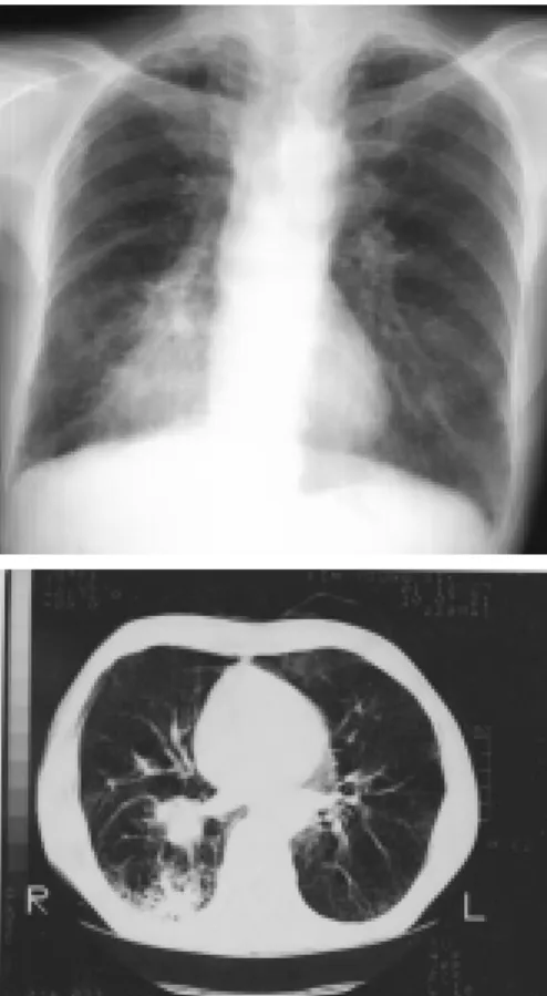 Fig.  2.  Chest  PA  on  postoperative  day(POD)  3  and  21  demonstrating  postresectional  air  space  and  collased  lung