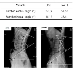 Fig. 2. Lumbar cobb’s angle (A, pre: 62.19°, post 1: 