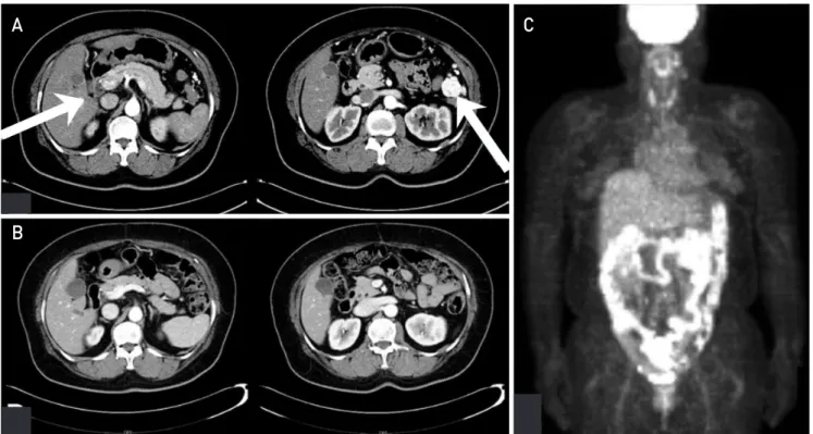 Fig. 1. (A) Preoperative abdominopelvic computed tomography shows 24-mm arterial well-enhancing mass at segment 5 of liver and 30-mm well-en- well-en-hancing omental mass at paracolic gutter space