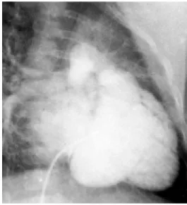 Fig.  1.  Right  ventriculography  demonstrates  atrialized  ventricle.