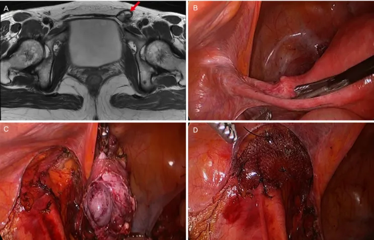 Fig. 1. (A) Magnetic resonance imaging of the pelvis showing a 4×3 cm cystic structure in the left inguinal area (red arrowhead)
