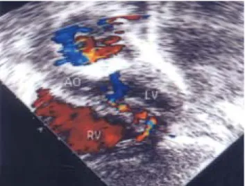 Fig.  4.  Preoperative  selective  coronary  angiograms.  A)  In  the  early  phase  of  injection  from  the  aortic  root,  only  the  left  coronary  artery  is  opacified