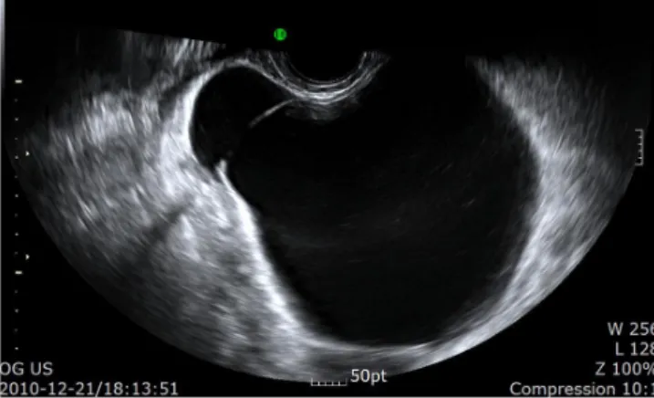 Fig. 1. Transvaginal ultrasound indicating a large 10×8×7 cm³ sized cys- cys-tic mass at the center of the pelvic cavity, with internal septation and no  apparent solid portion.