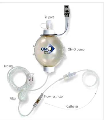 Fig. 2. Elastometric pump filled with local anesthetic. The protec- protec-tive cap is first removed from the pump, a syringe filled with local  anesthetic is attached to the fill port, and the fluid is injected into  the pump