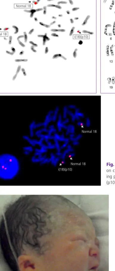 Fig. 1. (A, B) Conventional karyogram showing two copies of the p arm  on chromosome 18