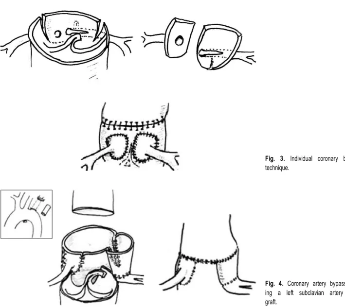 Fig. 3. Individual coronary button  technique.