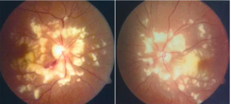 Fig. 1. The retinal photography shows characteristic multiple cotton-wool exudates, known as Purtscher flecken, in both eyes and a retinal  splinter hemorrhage in the right eye.