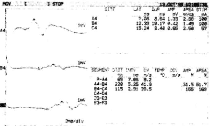 Fig.  1.  The  finding  of  electrophysiologic  study  performed  on  day  2  following  the  onset  of  weakness,  showing  the  prolonged  motor  distal  latencies,  temporal  dispersion,  and  partial  motor  conduction  blocks.