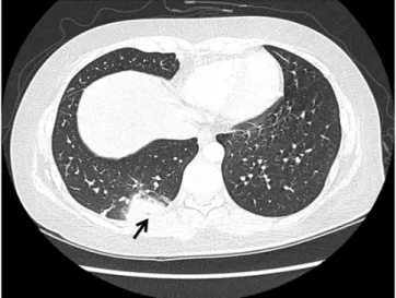 Fig. 2. Lower extremity venogram computed tomography (contrast  enhanced) showing diffuse deep vein thrombosis (arrow) below  the level of left external iliac vein.