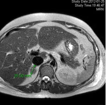 Fig. 2. Pathological examination after adrenalectomy. (A) Microscopic. (B) Gross (H&amp;E, ×40).