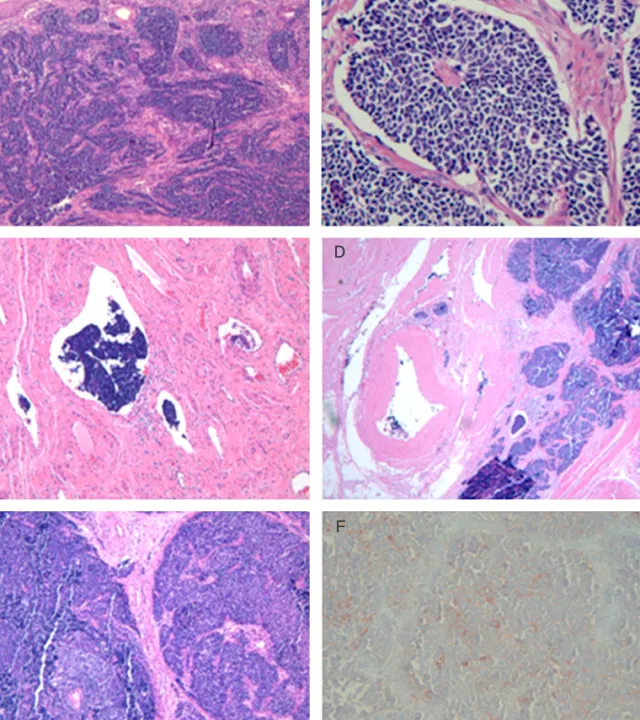 Fig. 2. Photomicrograph of the cervical tumor (A, B). Note that the cells are small in size with hyperchromatic round  nuclei and scanty cystoplasm (A, H&amp;E, ×40; B, H&amp;E, ×200)