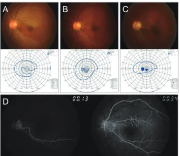 Fig. 3. Graphs showing initial and final best-corrected visual  acuity (BCVA) between eyes with cilioretinal artery sparing and  non-sparing central retinal artery occlusion (CRAO)