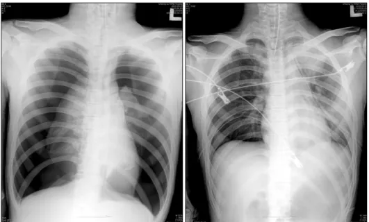 Fig. 1. X-ray upon admission to  the emergency room, showing  simul-taneous bilateral sponsimul-taneous  pneu-mothorax, left