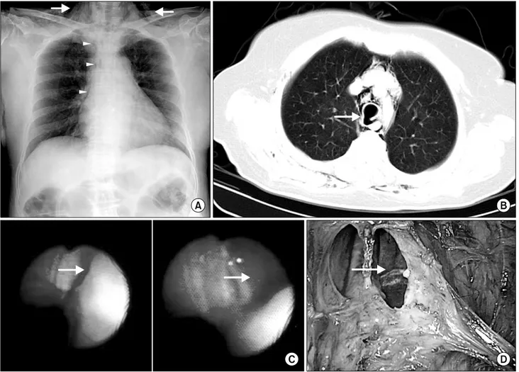 Fig. 1. A chest film shows subcutaneous emphysema of the neck and pneumomediastinum (A), and computed tomography scans of the  chest show subcutaneous emphysema and disappearance of tracheal posterior membranous wall continuity (B)