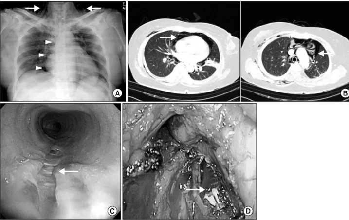 Fig. 2. A chest film shows a marked pneumomediastinum and subcutaneous emphysema of neck (A) and computed tomography scans of  chest show marked pneumomediastinum and pneumopericardium but does not show lesions indicating tracheal or esophageal injury (B)
