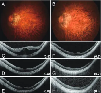 Fig. 2. A case of myopic traction maculopathy after pars plana  vitrectomy with gas tamponade