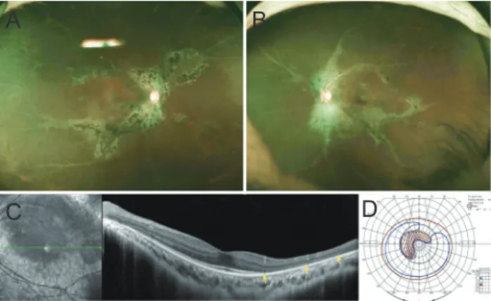 Fig. 1. The bony-spicule shaped retinochoroidal atrophy with  pigmentation along retinal veins: wide fundus photography of the  patient’s (A) right eye and (B) left eye
