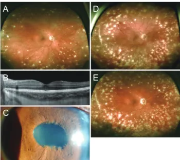 Fig. 1. (A) 11 months before the treatment of adalimumab. Color  fundus photography showing sunset glow fundus changes with  diffuse Dalen-Fuchs nodules, consistent with  Vogt-Koyanagi-Ha-rada disease