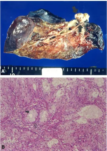 Fig.  1.  Preoperative  chest  X-ray  :  atelectatic  change  and  bronchiectasis  in  right  lower  lobe.