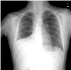 Fig.  4.  Postoperative  chest  X-ray  :  No  active  lesion  in  both  lung  field. 서  치료  받은  후  술  후  1일째  일반  병실로  이동하였고,  술  후  4일째와  5일째  흉관을  제거하였다