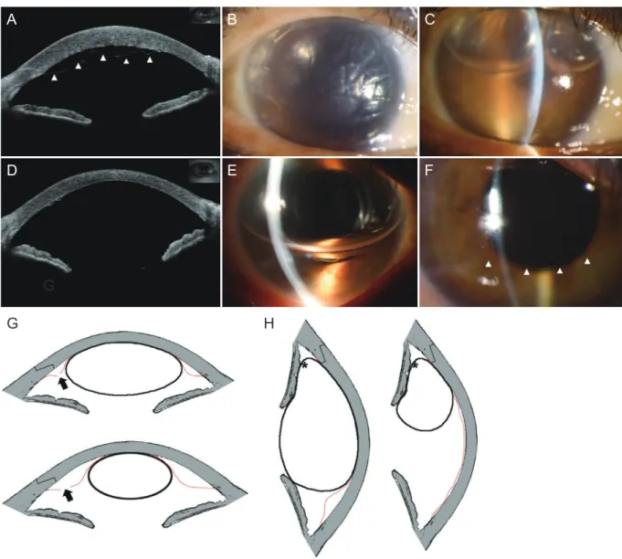 Fig. 1. A comparison of supine and lateral decubitus position after gas tamponade. (A) Anterior optical coherence tomography revealed  total Descemet’s membrane detachment (DMD) (arrowheads)