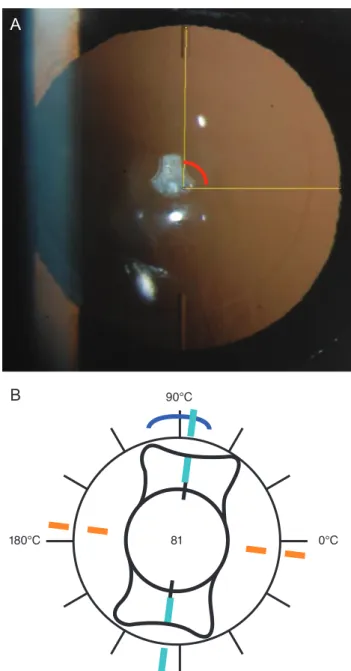 Fig. 1. (A) Anterior segment image showing intraocular lens axis  measurement using ImageJ (B) in comparison with the intended  axis.