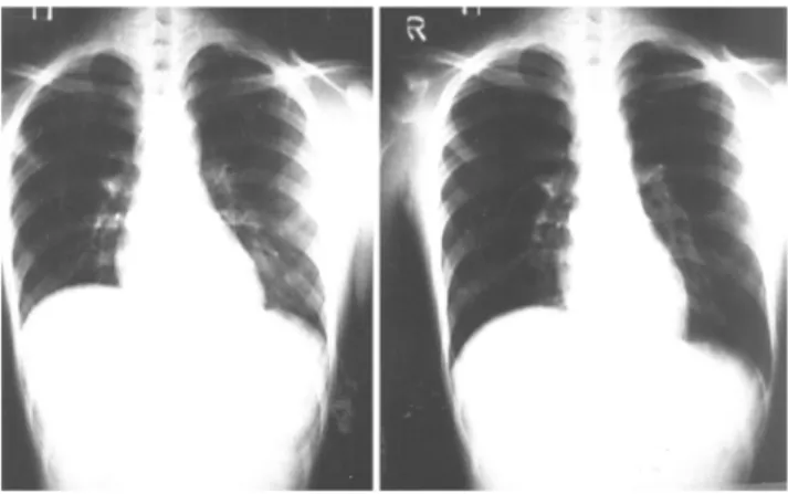 Fig.  3.  Chest  films  immediately  after  division  of  right  phrenic  nerve.  Diaphragm  was  elevated  at  the  expiratory  end  (left)  and  the  inspiratory  end  (right).