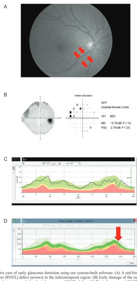 Fig. 2. A representative case of early glaucoma detection using our custom-built software
