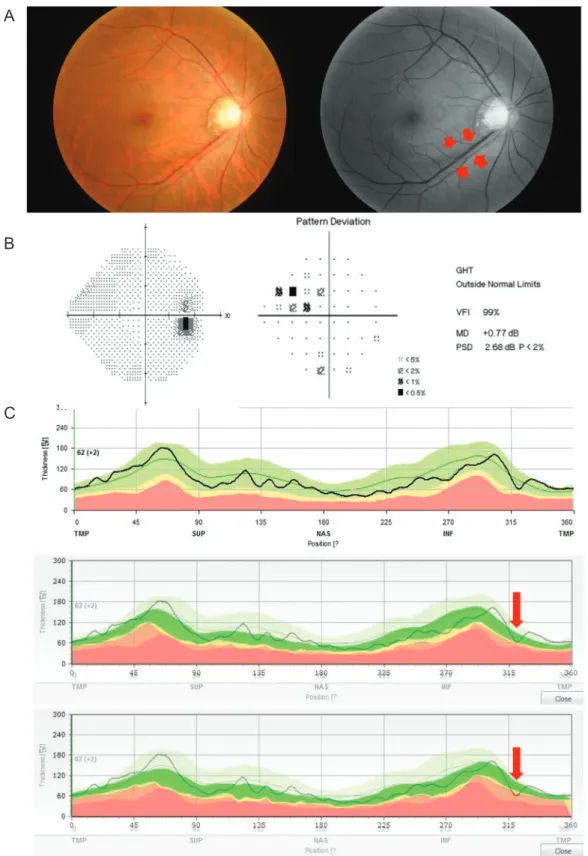 Fig. 3. A representative discordance case shows the detection ability of criterion 3 in the early diagnosis of glaucoma