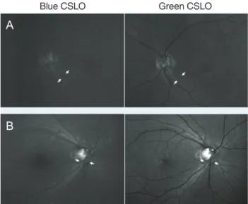 Fig. 2. Representative confocal scanning laser ophthalmoscope  (CSLO) imaging of the blue better group