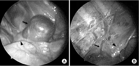 Fig. 1. Dynamic contrast enhanced computed tomography showed  a well-defined and oval-shaped mass at the right tracheobronchial angle, and the mass was markedly enhanced after the injection of  contrast medium.