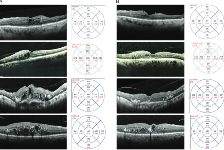 Fig. 1. (A) Retinal architectural changes between baseline and (B) 3 months after switching to aflibercept injection