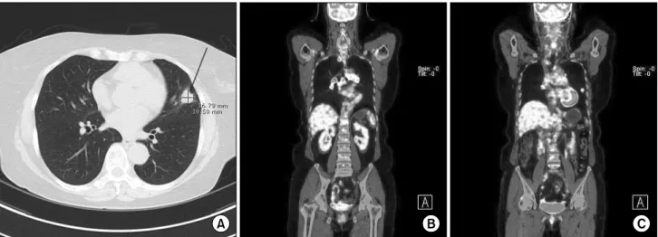 Fig. 2. Chest CT (A) and PET-CT (B, C) show a suspicious malignant tumor in the lingular segment and multiple bilateral mediastinal  lymph node metastases