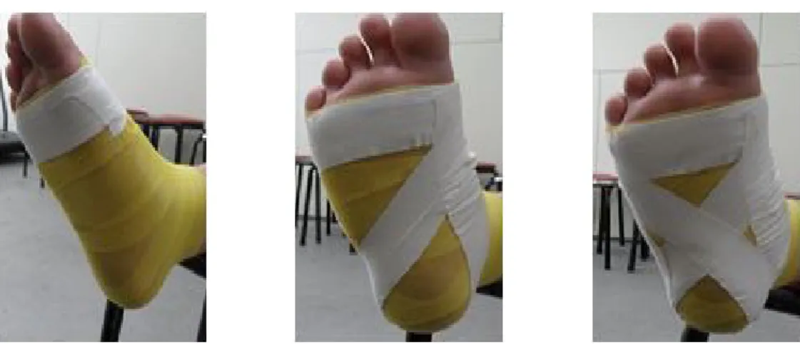Figure  1.  Arch  support  taping  for  excessive  pronated  foot 준으로 임의의 5번의 스텝을 선택하여 최고값과 최