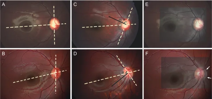 Fig. 2. Representative cases showing the development of optic-disc torsion. (A) Baseline fundus photograph of a 4-year-old girl
