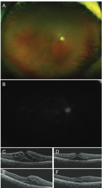 Fig. 1. Ocular findings at initial presentation. (A) Fundus examina- examina-tion showed a few retinal hemorrhages