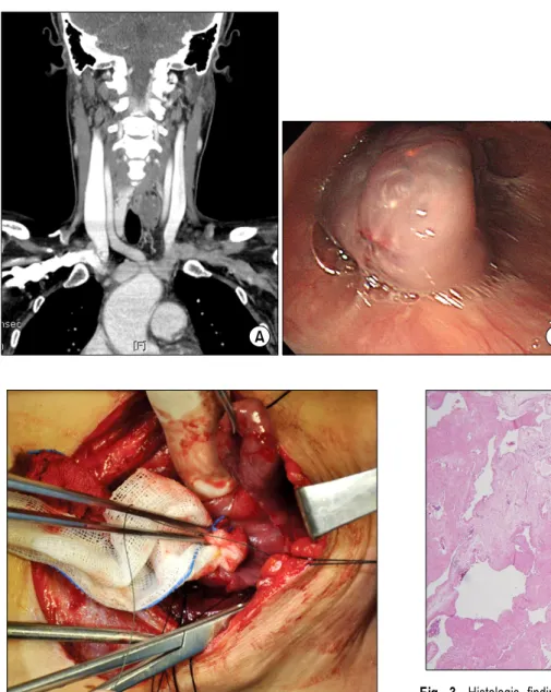 Fig. 1. (A) Neck and chest CT. 3.6  cm oval mass with slightly low  at-tenuation in the upper esophagus  and a 7 mm nodule in the left lobe  of the thyroid gland