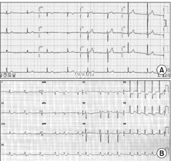 Fig. 1. (A) Preoperative normal electrocardiography. (B) Postopera- Postopera-tive electrocardiography shows ST-segment depression in V4, V5,  V6, lead II, lead III.