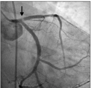 Fig. 1. A preoperative coronary angiography shows critical in-stent  restenosis of the proximal left anterior descending artery (arrow).
