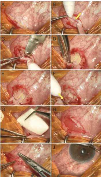 Fig. 1. Encapsulated bleb excision with collagen matrix implanta- implanta-tion. (A) Conjunctival incision 10 mm from the corneal limbus
