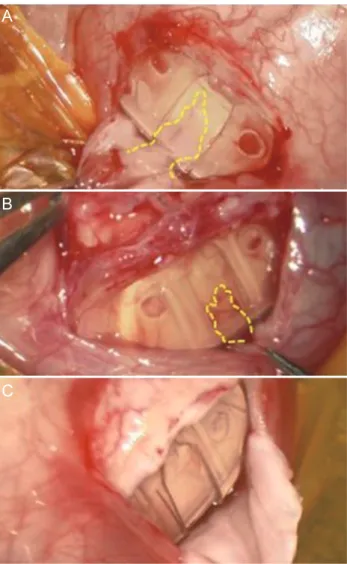 Fig. 3. The postoperative mean intraocular pressure (IOP) of  patients. The postoperative time points were 2 weeks, 1 month,  2 months, 4 months, and 6 months