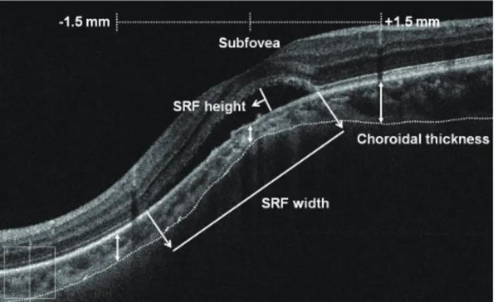 Fig. 1. An enhanced depth imaging optical coherence tomogra- tomogra-phy image demonstrating the morphologic parameters measured  in this study