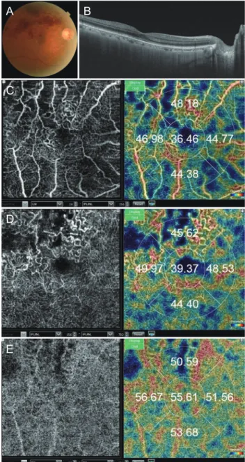 Fig. 1. A branch retinal vein occlusion case. (A) Fundus photo- photo-graph. (B) B-scan image of optical coherence tomography shows  no edema