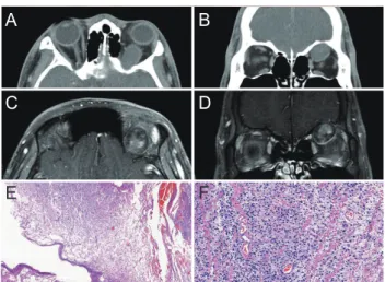 Fig. 1. Radiological and histological appearance of orbital malignant  peripheral nerve sheath tumor