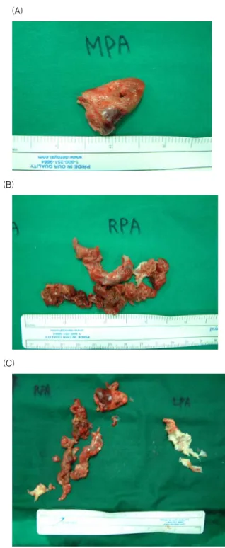 Fig.  2.  Preoperative  CT  shows  complete  obstruction  of  right  main  pulmonary  artery  and  left  lower  interlobar  artery