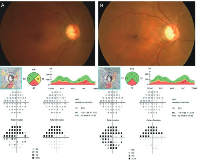 Fig. 2. Representative case of the right eye of a 54-year-old female patient with bilateral primary open-angle glaucoma
